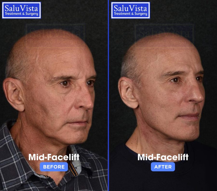 Revitalise Your Appearance with an Endoscopic Facelift