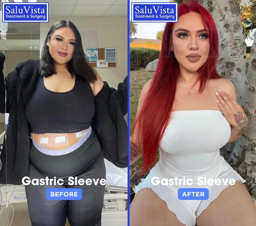 5 Signs Gastric Sleeve Surgery Might Be Right for You